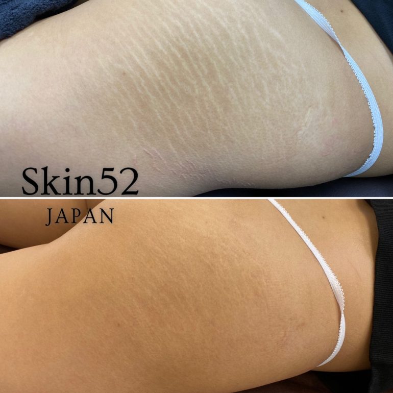スカーレス 傷跡修正アートメイク Skin52 スキン52 長野で美容皮膚科ならウェンデルクリニック