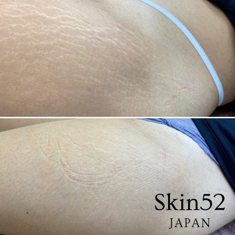 スカーレス 傷跡修正アートメイク Skin52 スキン52 長野で美容皮膚科ならウェンデルクリニック